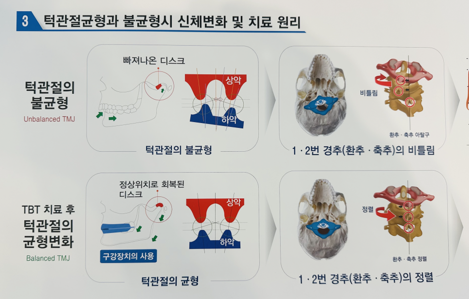 턱관절 불균형과 균형 변화에 대한 설명. 위쪽은 불균형 상태로 디스크가 빠져나와 있고, 아래쪽은 TBT 치료 후 균형이 회복된 상태를 보여준다. 척추의 비틀림과 정렬 상태도 비교하고 있다.